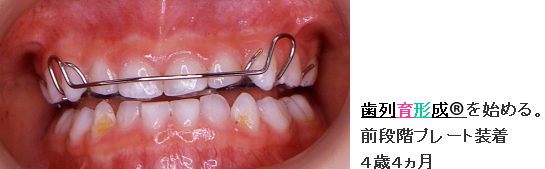 症例１ 歯列育形成を始める。 前段階プレート装着 ４歳４ヵ月