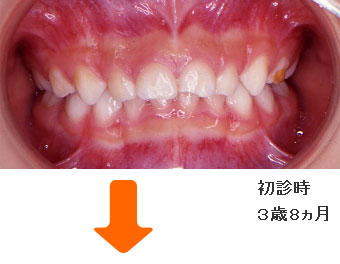 症例２ 初診時 ３歳８ヵ月