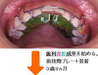 症例２ 前段階プレート装着 ３歳８ヵ月
