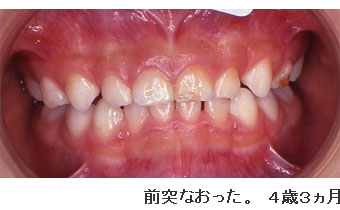 症例２ 前段階プレート装着 ３歳８ヵ月