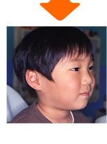 症例２ 前段階プレート装着 ３歳８ヵ月