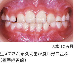 症例３ 前段階プレート装着 ３歳８ヵ月