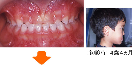 症例４ 初診時　４歳４ヵ月