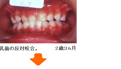 症例５ ２歳３ヵ月