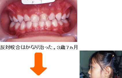 症例５ ３歳７ヵ月・７歳１１ヵ月
