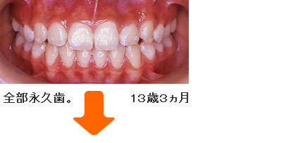 症例５ １３歳３ヵ月