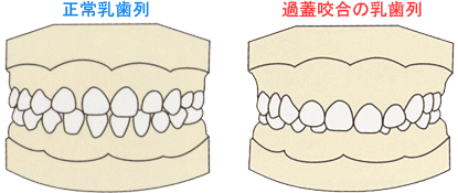 過蓋咬合