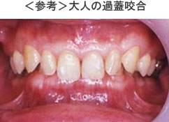 ＜参考＞大人の過蓋咬合