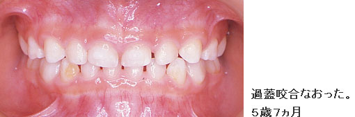症例1 過蓋咬合なおった。 5歳7ヵ月